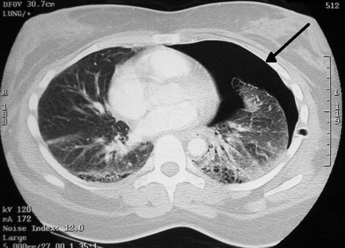 CT scan of pneumothorax